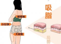 超声波抽脂恢复期多久？影响恢复的关键因素公布啦