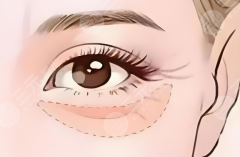 外路去眼袋恢复期有多久？恢复期避雷指南|别等留疤才看