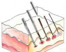 黄金微针的注意事项有哪些？这几个关键注意事项帮你锁恢复情况_新手必看