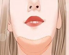 自体脂肪垫下巴能维持多长时间？影响维持时间的关键这里有