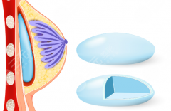 曼托和星熠区别在哪？内行人扒清2大假体差异|小白也能看懂