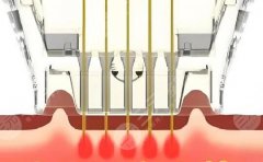 黄金微针和热玛吉的区别在哪？3分钟搞懂俩“抗衰神器”的真实差别