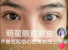 齐鲁医院割双眼皮找哪个医生?别只看“头衔”,“术式+风格”精准匹配 齐鲁医院割双眼皮找哪个医生?别只看“头衔”,“术式+风格”精准匹配