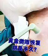 双下巴黄金微雕后多久可以恢复?最新恢复时间表+真实案例+学术支撑,不踩恢复坑 双下巴黄金微雕后多久可以恢复?最新恢复时间表+真实案例+学术支撑,不踩恢复坑