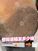 台州市立医院植发价格：头顶加密种植，32000元拯救“稀疏头顶”