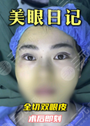 山东省立医院割双眼皮怎么样？灵动大眼，自然度+安全性双在线
