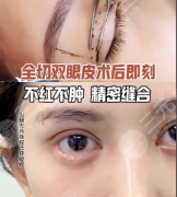 台州市立医院割双眼皮多少钱？台州市立医院双眼皮附加服务&优惠政策表
