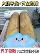 衢州中医院吸脂怎么样？中医+微创双buff，三甲塑形不反弹还安全