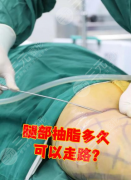 大腿吸脂手术多久可以恢复?2025精准恢复表+案例,消肿塑形不踩坑 大腿吸脂手术多久可以恢复?2025精准恢复表+案例,消肿塑形不踩坑