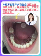 苏北医院种植牙怎么样？复杂病例“hold住”，不用跨城奔波