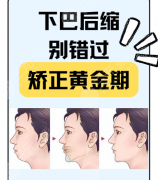 下巴后缩正颌手术风险大吗?有人风险低有人遭罪,3个核心可控因素 下巴后缩正颌手术风险大吗?有人风险低有人遭罪,3个核心可控因素