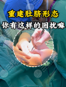 肚脐整形有微创手术吗？2025实测技术+案例+避坑指南，疤痕隐形超安心
