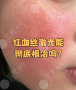 激光祛红血丝可靠吗?片状泛红+轻微红血丝,选强脉冲光IPL 激光祛红血丝可靠吗?片状泛红+轻微红血丝,选强脉冲光IPL