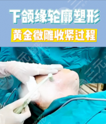 双下巴黄金微雕适合什么样的人?5类人群精准匹配+2大核心禁忌 双下巴黄金微雕适合什么样的人?5类人群精准匹配+2大核心禁忌
