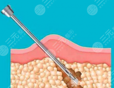 超声溶脂和光纤溶脂哪个安全?风险点各有侧重,避坑关键看适配 超声溶脂和光纤溶脂哪个安全?风险点各有侧重,避坑关键看适配