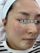 苏北人民医院祛斑怎么样?医生天团实战派坐镇,精准对症 苏北人民医院祛斑怎么样?医生天团实战派坐镇,精准对症