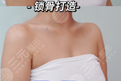 锁骨整形有什么后遗症?和“术式+医院”直接挂钩 锁骨整形有什么后遗症?和“术式+医院”直接挂钩