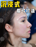 眉弓骨填充多少钱?填充价格=材料+技术+安全保障 眉弓骨填充多少钱?填充价格=材料+技术+安全保障