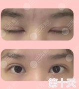 南昌第二附属医院割双眼皮怎么样?平行型、开扇型、新月型,避免“千人一眼” 南昌第二附属医院割双眼皮怎么样?平行型、开扇型、新月型,避免“千人一眼”
