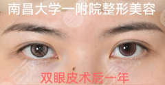 南昌二附院哪个医生割双眼皮好？避坑指南+面诊攻略，选对医生少走弯路