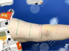 手臂黄金微雕多长时间能看到效果？7天消肿显线条