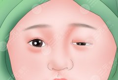 填眉弓可以改善眼皮下垂吗？眼皮下垂和眉弓关系有多大？附真实体验与科普