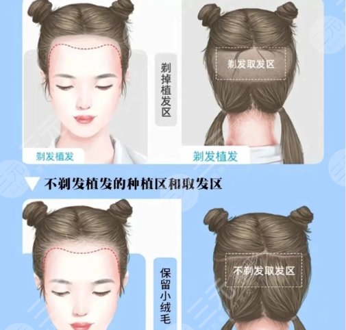 植发
