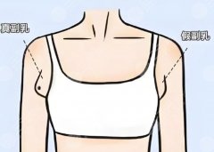 副乳抽脂恢复期多久？肿几天？疼几天？能上班几天？一次说清