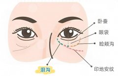 肤丽美填充泪沟怎么样？价格、效果、注意事项一网打尽