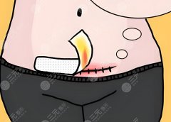 全腹壁祛皮祛脂效果好吗？从住院到拆线，全腹壁恢复期30天流水账