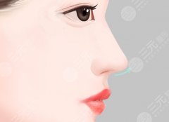 做鹰钩鼻手术拆线会痛吗？看了这份满意度表格再决定做不做