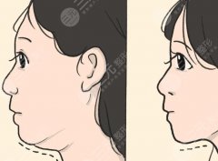 双下巴黄金微雕要拆线吗？价格、恢复、人群，一篇看懂