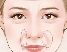 玻尿酸填充泪沟和法令纹后肿几天?肿胀日历公开,附价格表和真实打分 玻尿酸填充泪沟和法令纹后肿几天?肿胀日历公开,附价格表和真实打分