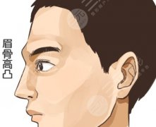 眉骨打玻尿酸会往下滑吗?下滑概率到底几成?给你拆个透 眉骨打玻尿酸会往下滑吗?下滑概率到底几成?给你拆个透