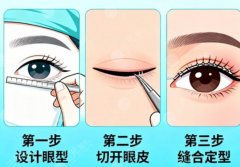 南昌大学第一附属医院做双眼皮要多少钱？价格走势提前说