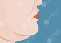 双下巴黄金微雕恢复期，术后30天细节清单，直接照抄就行