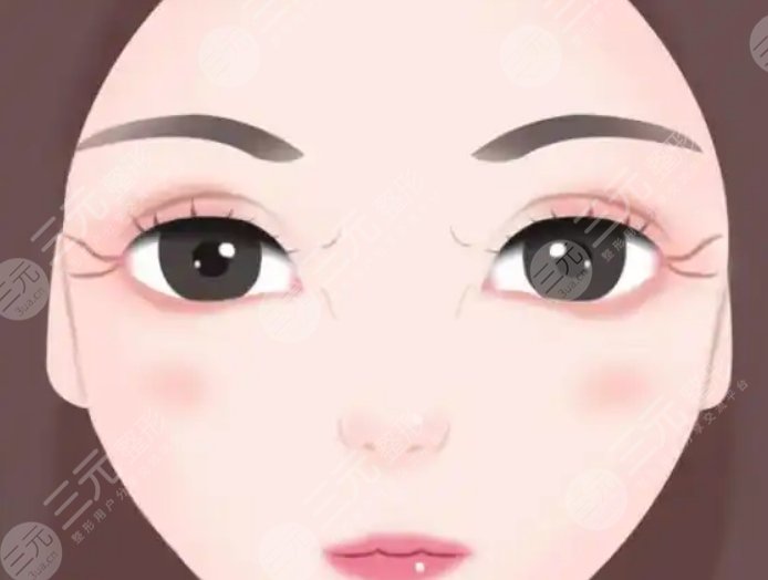 双眼皮
