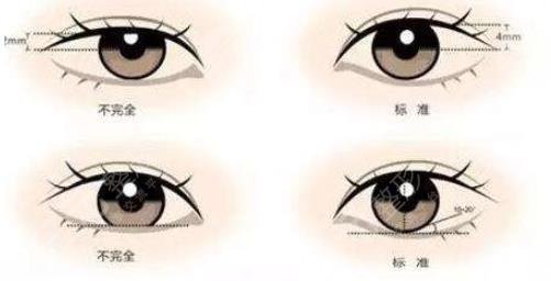 双眼皮
