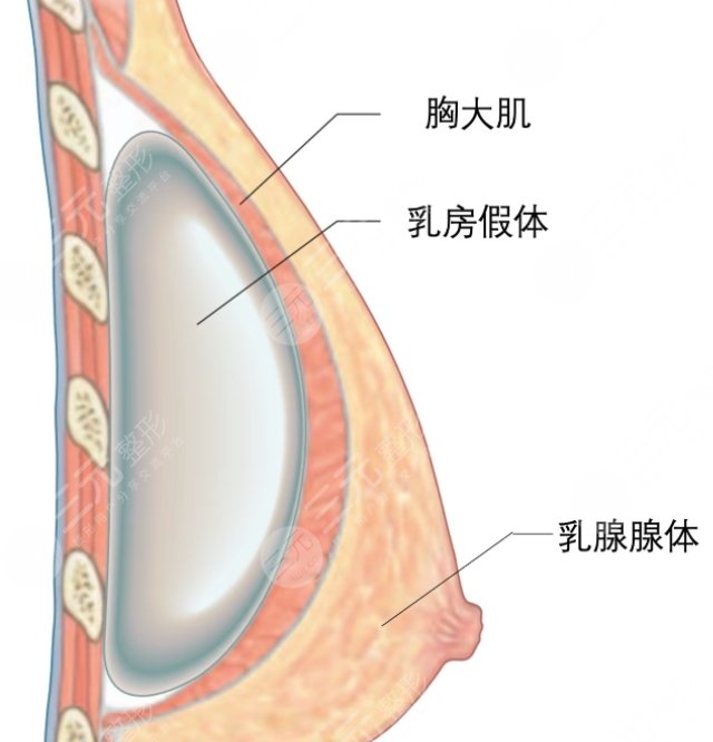 隆胸