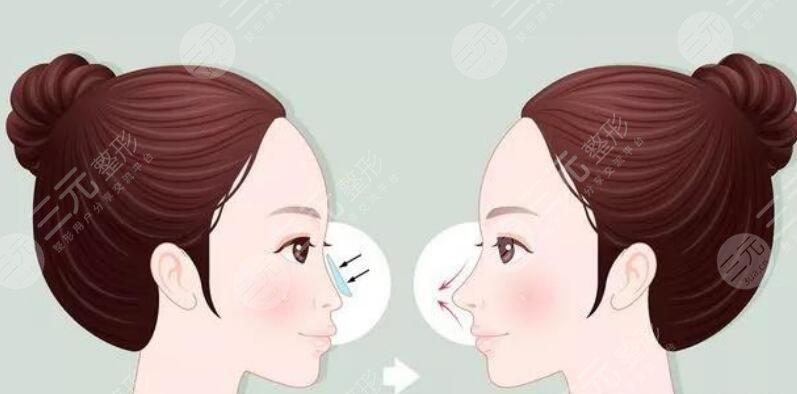 隆鼻