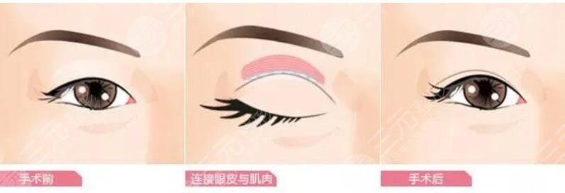 双眼皮