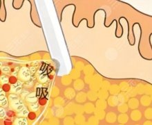 肩部吸脂好还是瘦肩针好？一文教你分清肩部吸脂和瘦肩针的区别