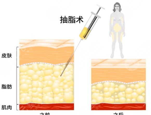 吸脂