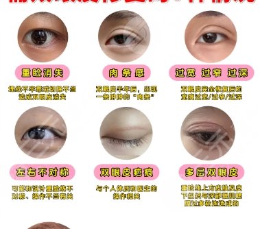 双眼皮
