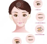 王朝根医生怎么样-双眼皮-眼整形-南昌鹏爱秀琪医疗美容医院