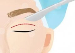 李安东医生怎么样-双眼皮-眼整形-米兰整形医疗美容