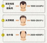 西宁第二人民医院植发多少钱？植发项目低至6100元起