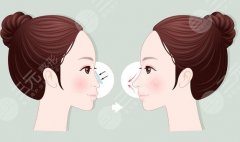 内蒙古医科大学附属医院假体隆鼻多少钱？2026年价格表更新！