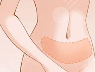 吸脂