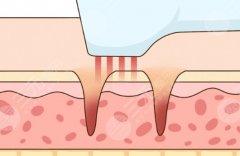 5d胶原光会加速衰老吗？别瞎猜了！内行人带你扒清真相